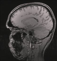 MRI Image